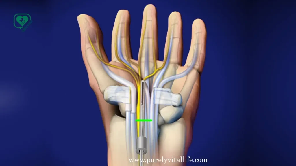 carpal tunnel release