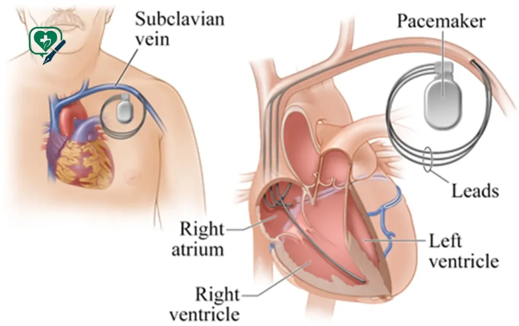 how the aicd medical abbrevation device operates