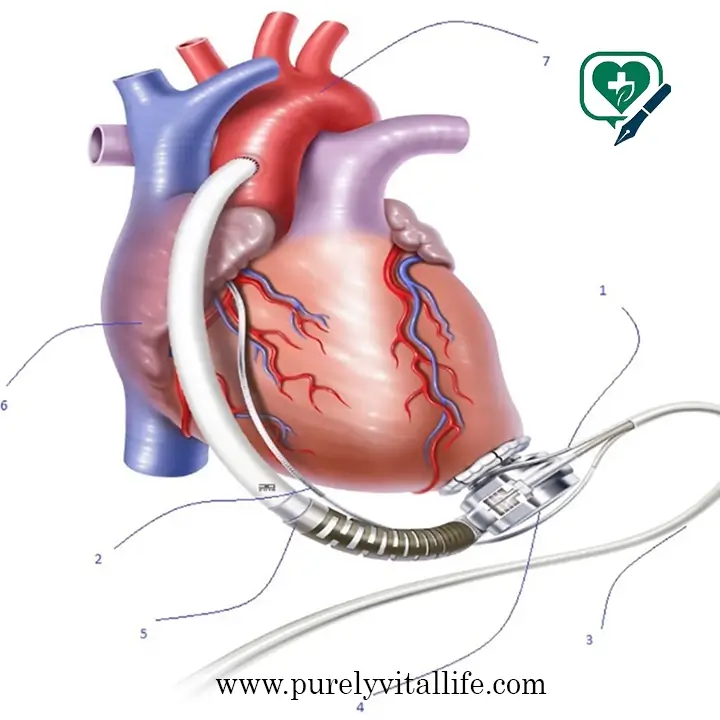 importance of aicd device in cardiology