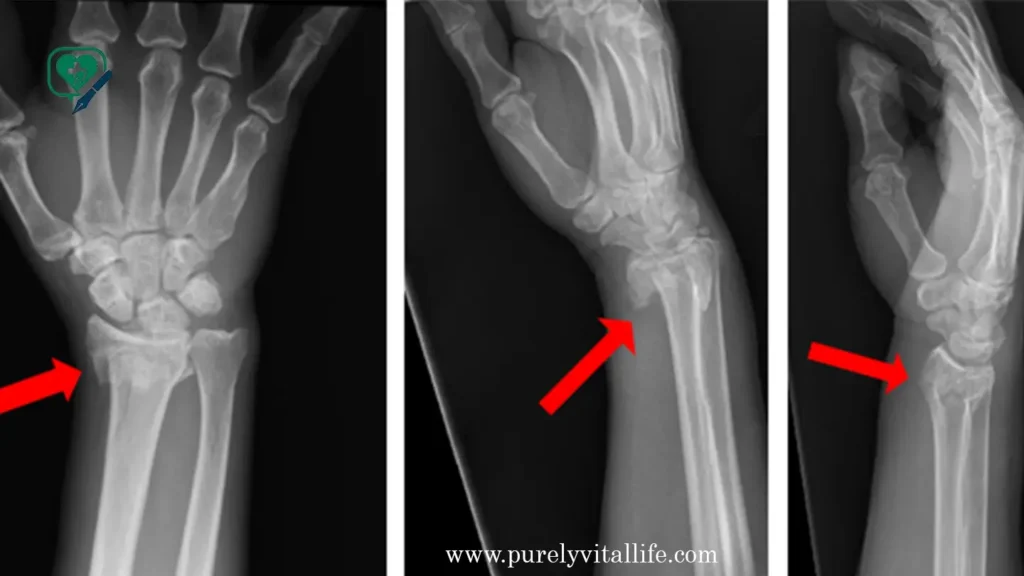 wrist fractures