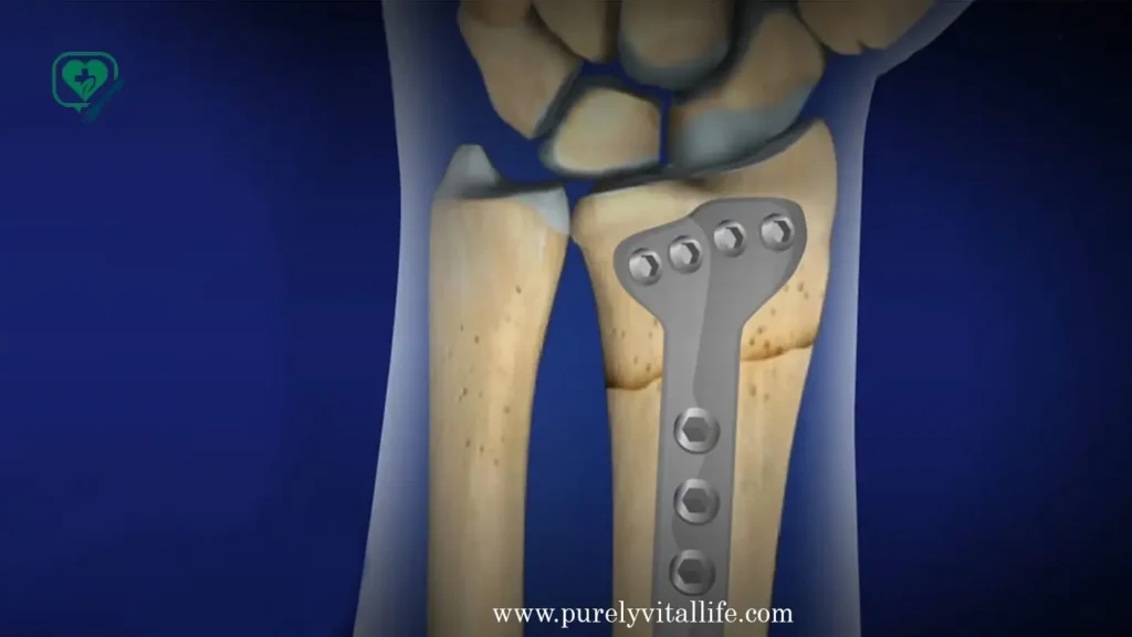 what is wrist surgery