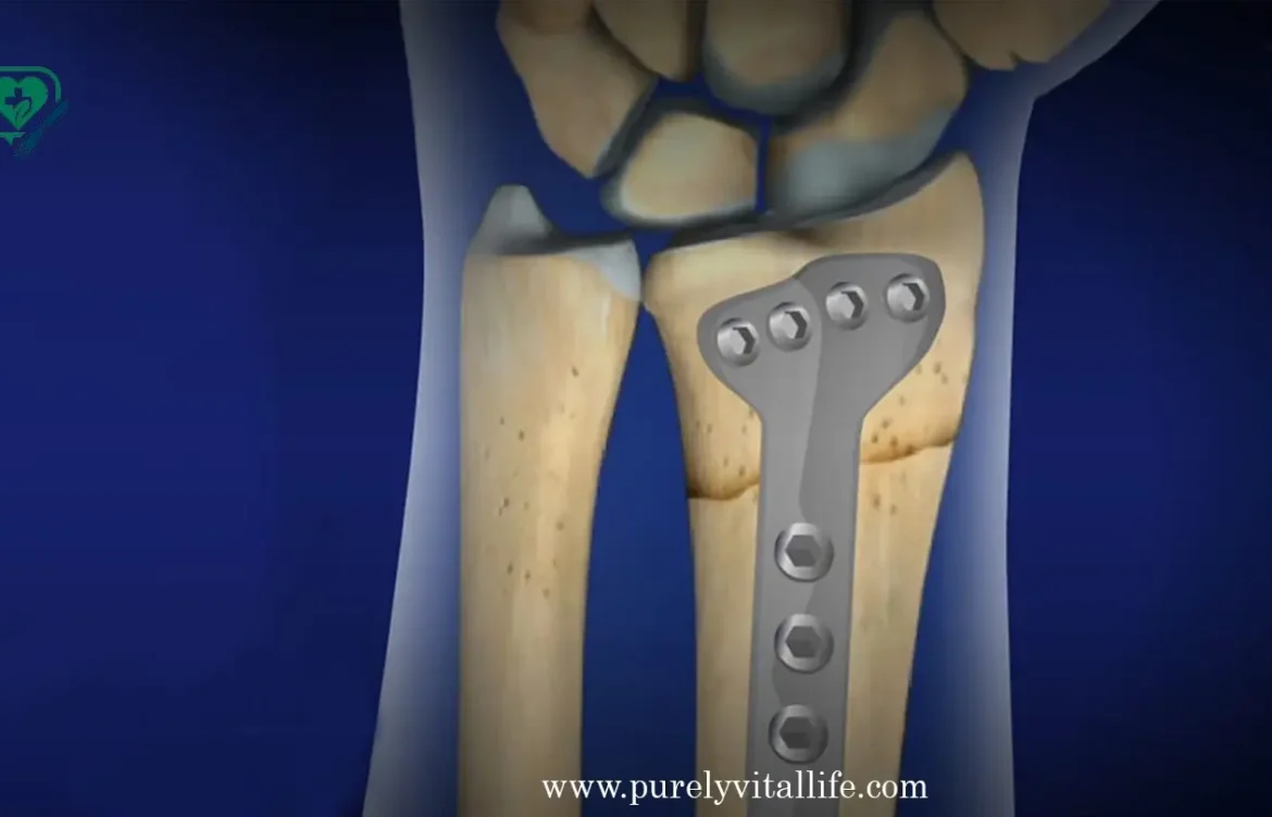Wrist Surgery Explained: Types, Benefits, and When You Might Need It
