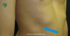 lump on rib
