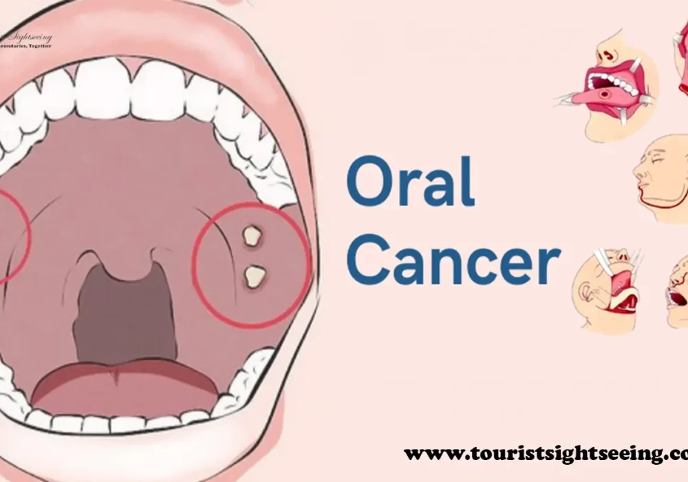 oral cancer stages, treatment, causes and all