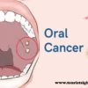 oral cancer stages, treatment, causes and all