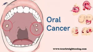 oral cancer stages, treatment, causes and all