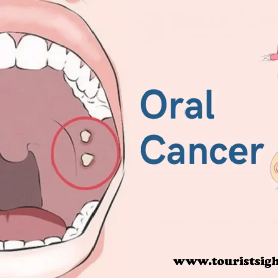 oral cancer stages, treatment, causes and all