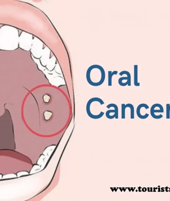 oral cancer stages, treatment, causes and all