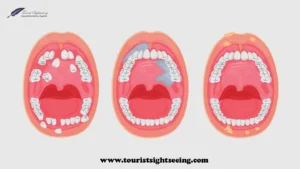 oral cancer stages