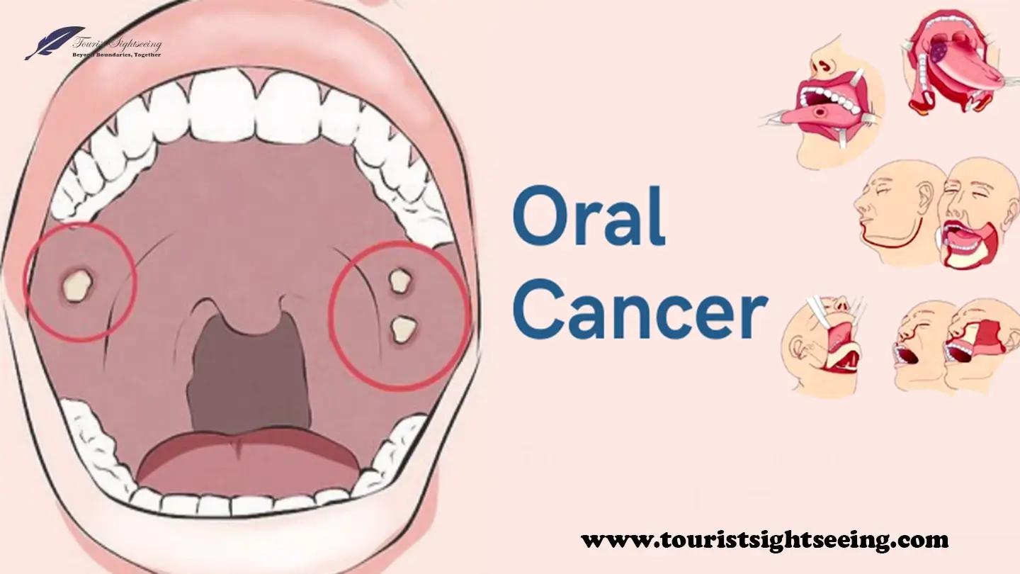 oral cancer stages, treatment, causes and all